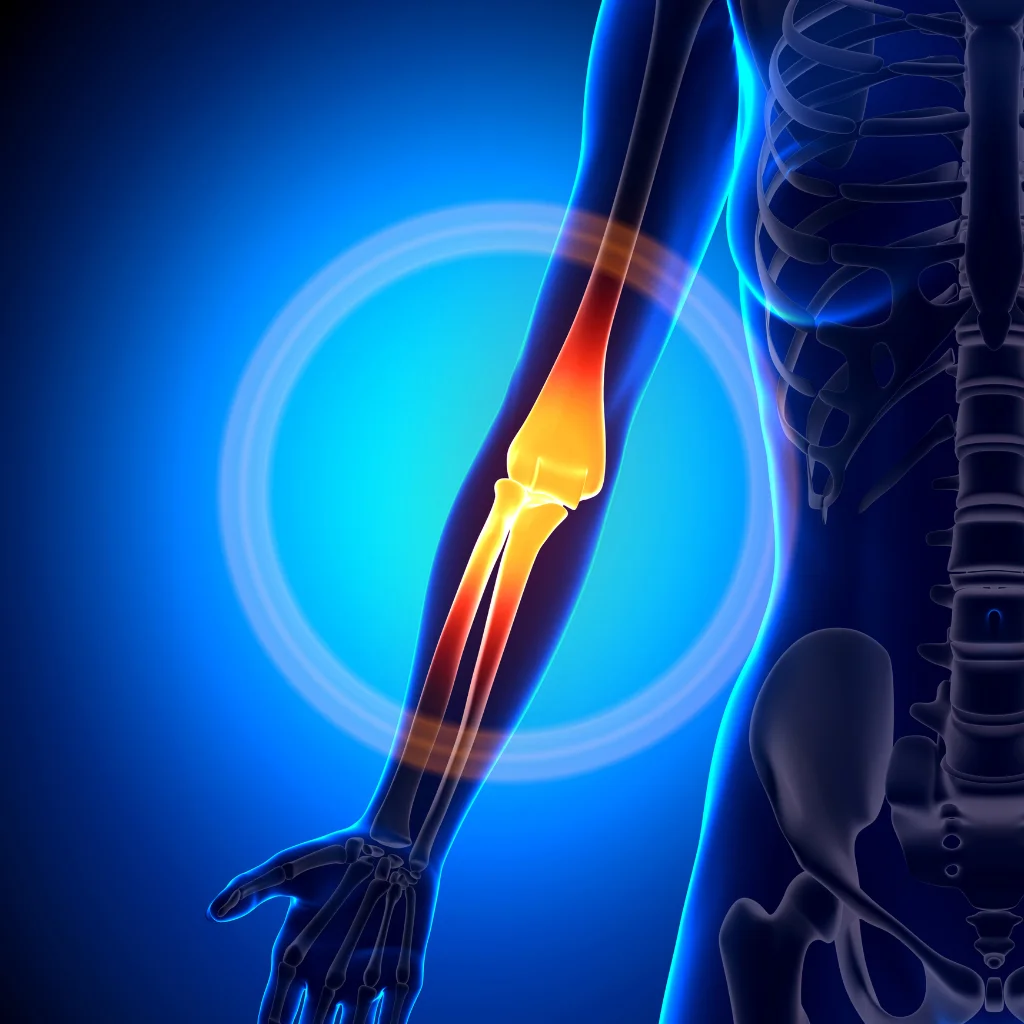 Illustration of an elbow with the painful area highlighted