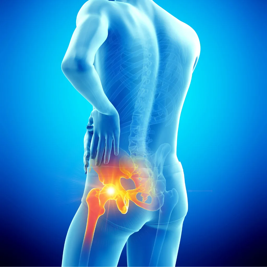 Medical illustration of a hip from behind with the bursa and outer hip joint glowing to mark where bursitis pain sits