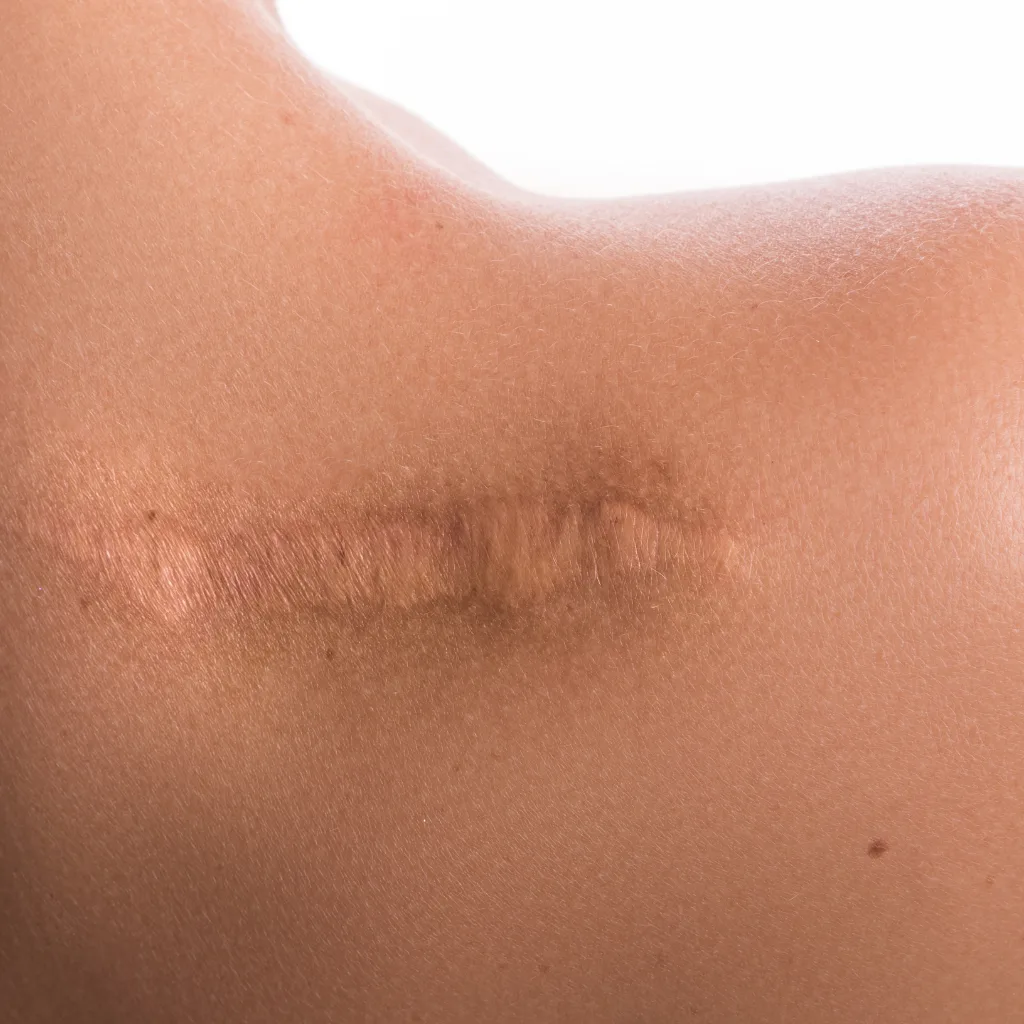 Close-up of a healed surgical scar running across a shoulder, the raised tissue visible along the incision line