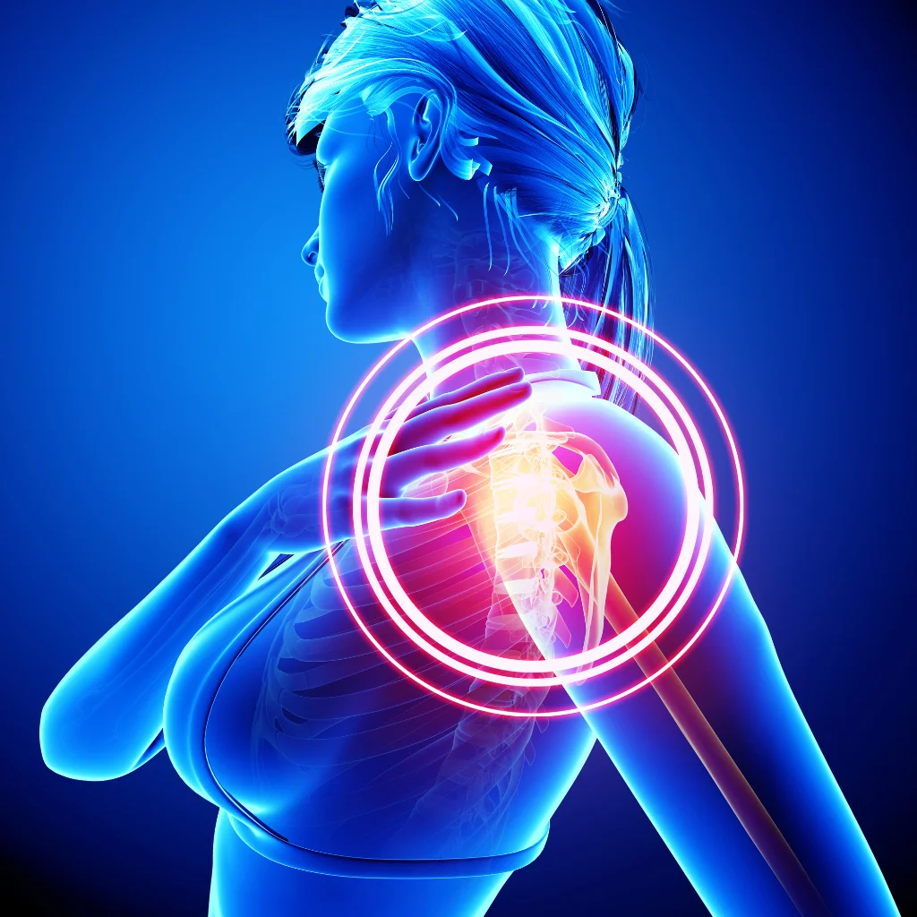 Illustration of a shoulder joint with the painful area highlighted